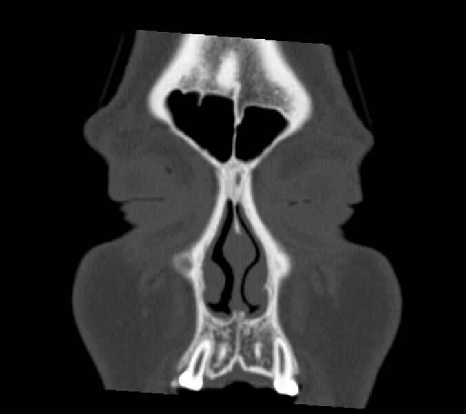 File:Antrochoanal polyp (Radiopaedia 21894-21868 Coronal bone window 3).jpg