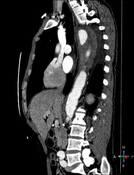 File:Aortic aneurysm and penetrating ulcer (Radiopaedia 23590-23704 C 25).jpg