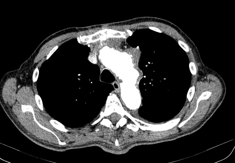 File:Aortic arch saccular aneurysm (Radiopaedia 19430-19457 B 2).jpg