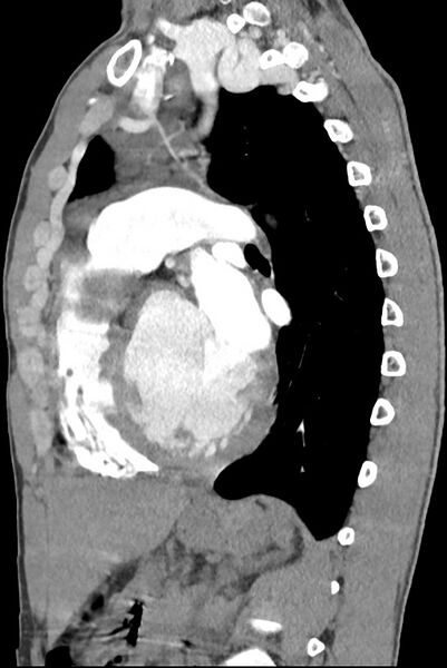File:Aortic coarctation with aneurysm (Radiopaedia 74818-85828 B 99).jpg