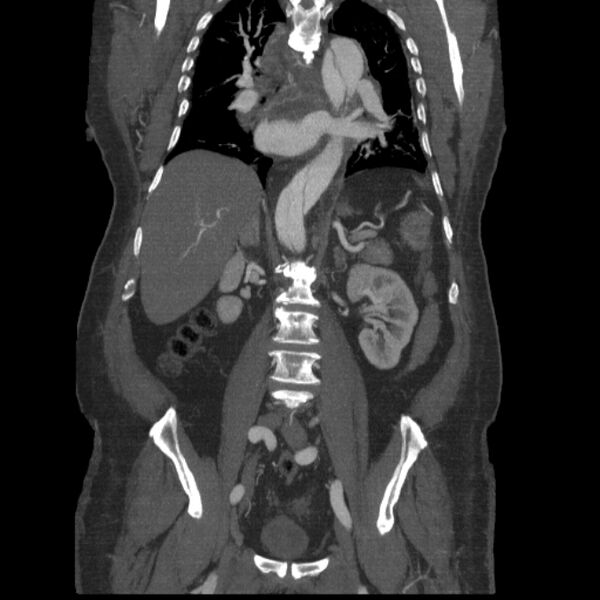 File:Aortic dissection (Radiopaedia 28802-29105 B 22).jpg