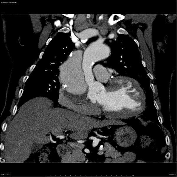 File:Aortic dissection - Stanford type A (Radiopaedia 26183-26315 A 20).jpg