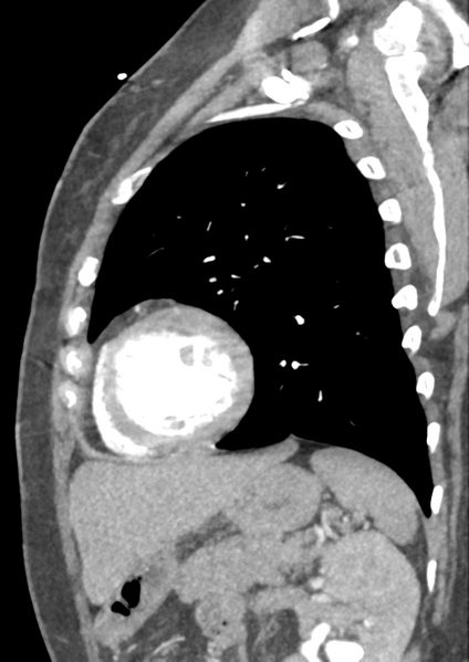 File:Aortic dissection - Stanford type B (Radiopaedia 50171-55512 C 5).png