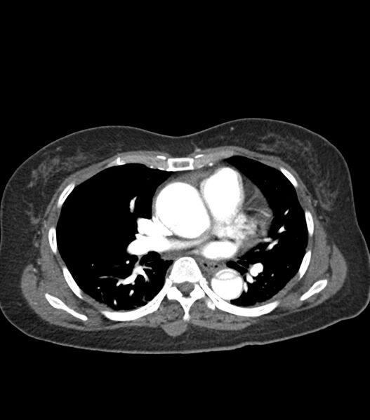 File:Aortic dissection with renal ischemia (Radiopaedia 76573-88338 A 32).jpg