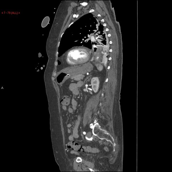 File:Aortic intramural hematoma (Radiopaedia 27746-28001 C 48).jpg