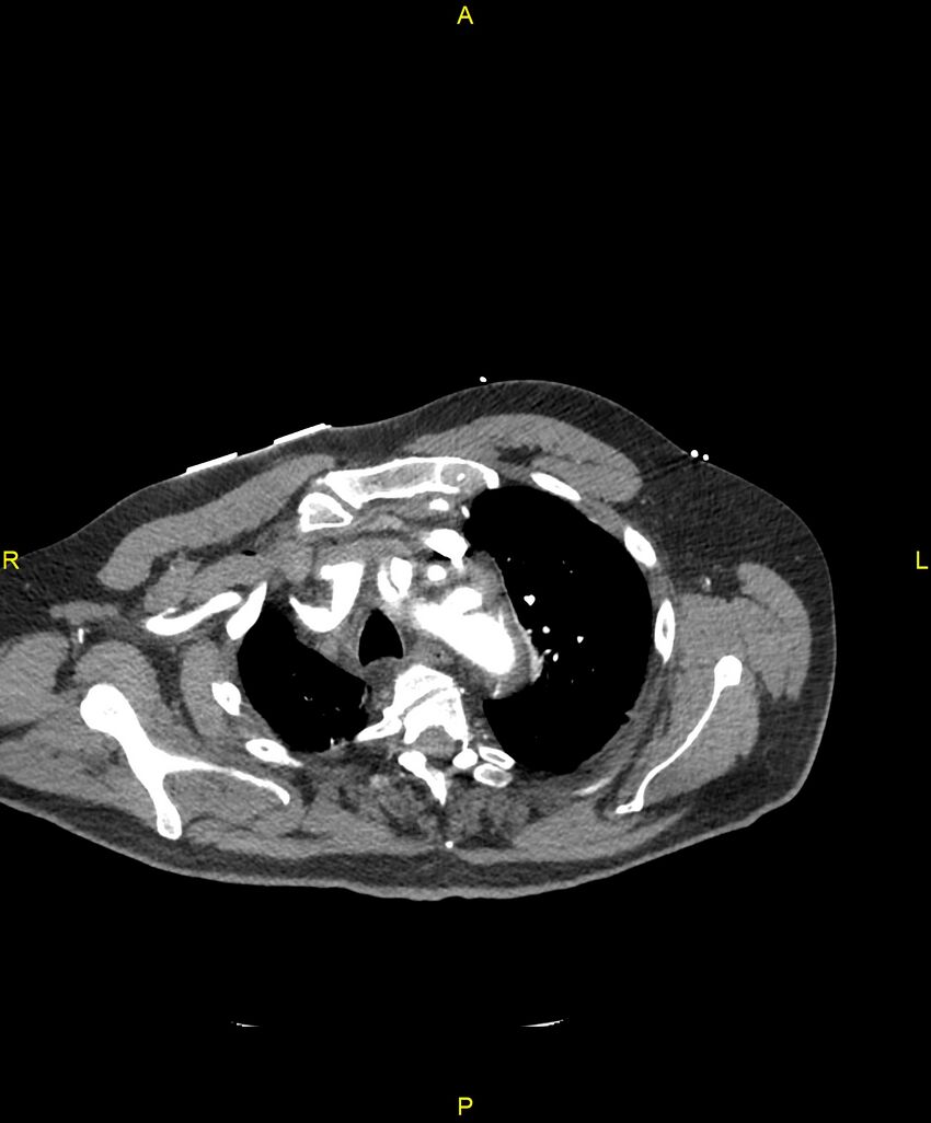 Aortic rupture (Radiopaedia 88822-105594 B 48).jpg