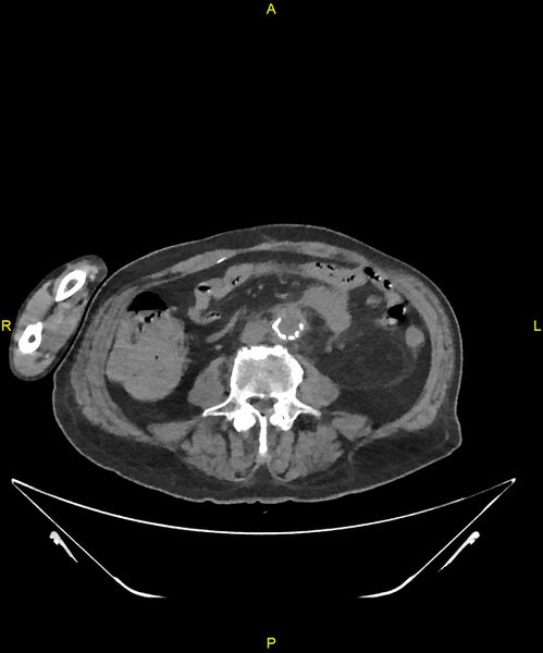 File:Aortoenteric fistula (Radiopaedia 84308-99603 Axial non-contrast 210).jpg