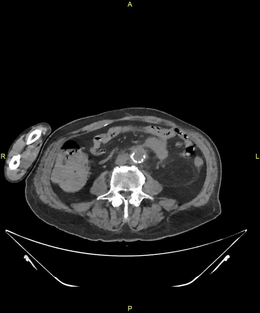Aortoenteric fistula (Radiopaedia 84308-99603 Axial non-contrast 210).jpg