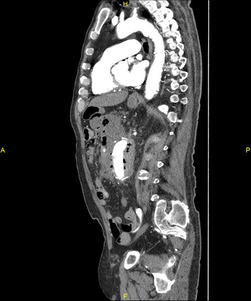 File:Aortoenteric fistula (Radiopaedia 84308-99603 C 205).jpg