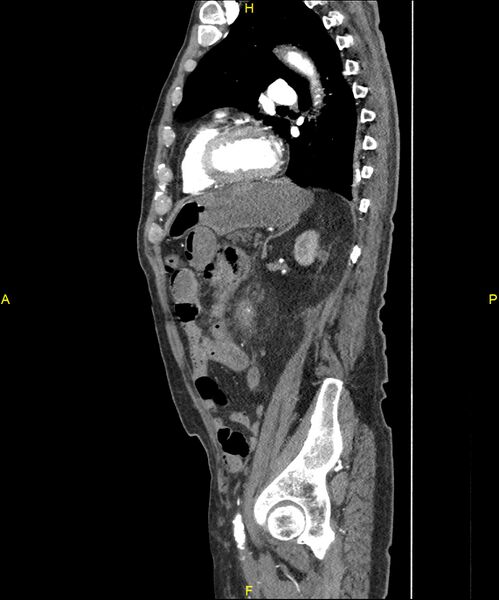 File:Aortoenteric fistula (Radiopaedia 84308-99603 C 230).jpg