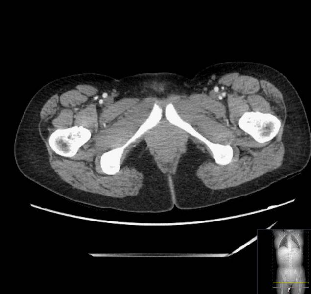 File:Appendicitis (CT angiogram) (Radiopaedia 154713-127660 Axial 100).jpg