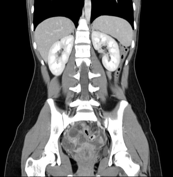File:Appendicitis and incidental bicornuate uterus (Radiopaedia 22833-22853 D 28).jpg