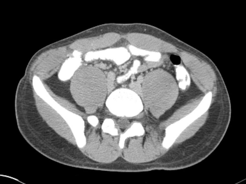Appendicitis and incidental foregut duplication cyst (Radiopaedia 52962-58916 A 60).jpg