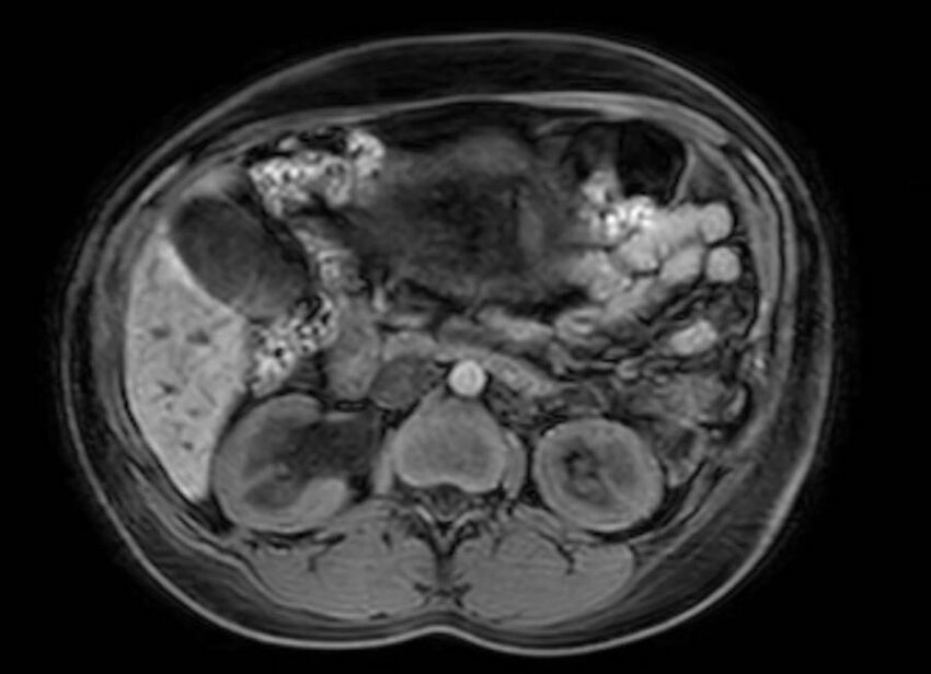 Appendicitis in gravida (MRI) (Radiopaedia 89433-106395 Axial DIXON 52).jpg