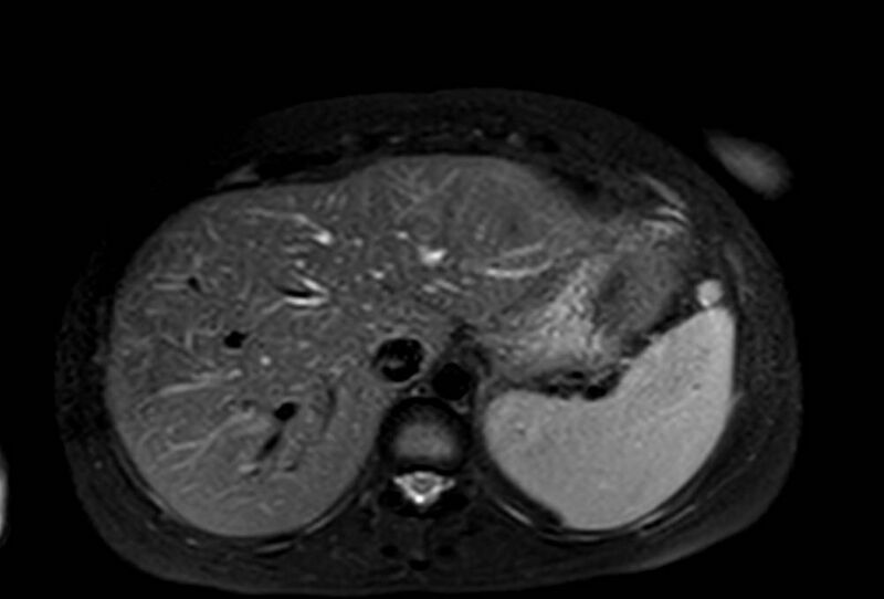 File:Appendicitis in gravida (MRI) (Radiopaedia 89433-106395 Axial T2 SPAIR 13).jpg