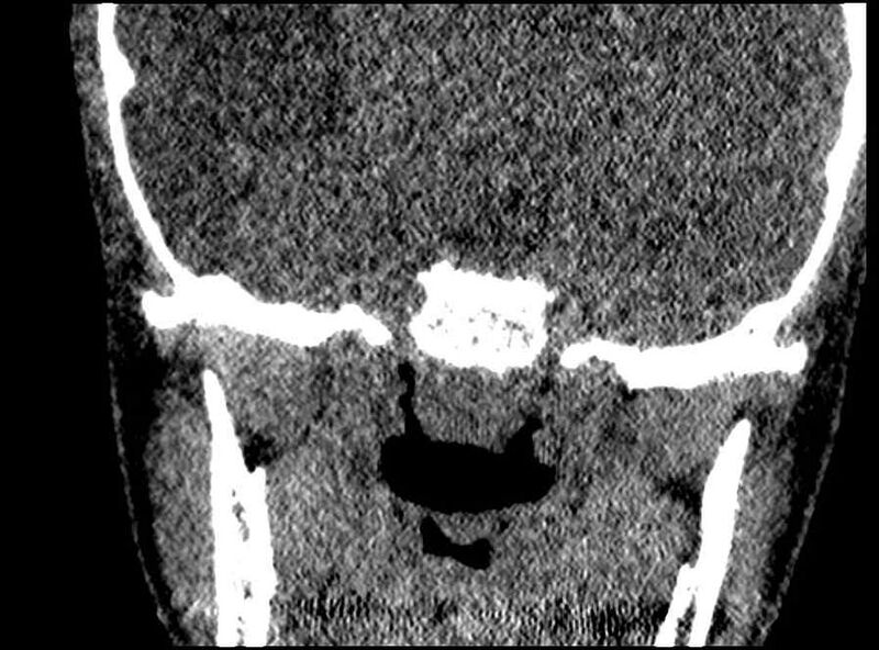 File:Arachnoid cyst- extremely large (Radiopaedia 68741-78450 Coronal bone window 4).jpg
