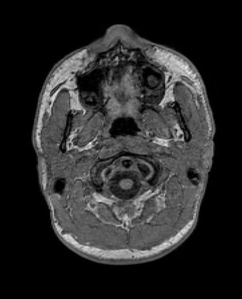 File:Arachnoid cyst- extremely large (Radiopaedia 68741-78451 Axial T1 4).jpg