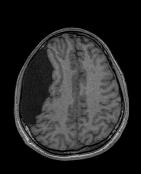 File:Arachnoid cyst- extremely large (Radiopaedia 68741-78451 Axial T1 55).jpg
