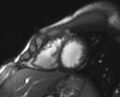 Arrhythmogenic right ventricular cardiomyopathy (Radiopaedia 69564-79464 short axis cine 73).jpg