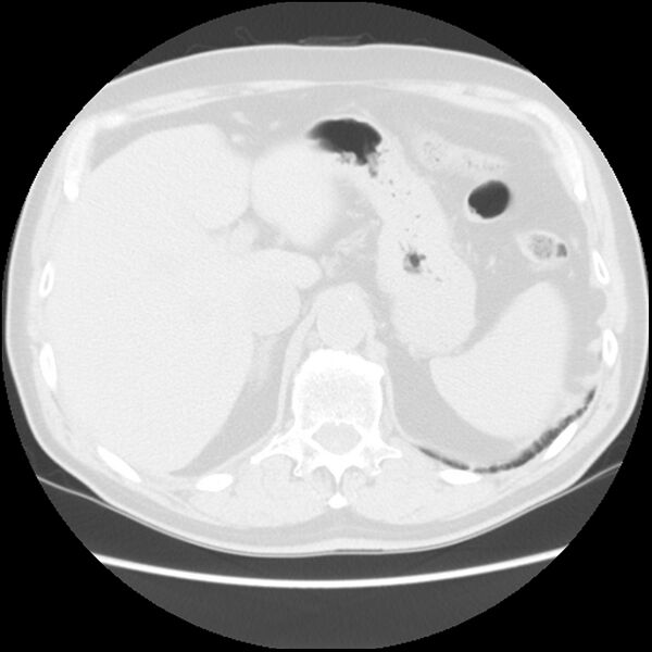 File:Asbestos-related pleural plaques (Radiopaedia 39069-41255 Axial lung window 68).jpg