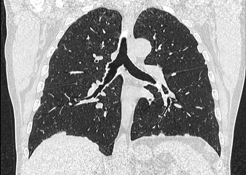 File:Asbestos pleural placques (Radiopaedia 57905-64872 Coronal lung window 167).jpg