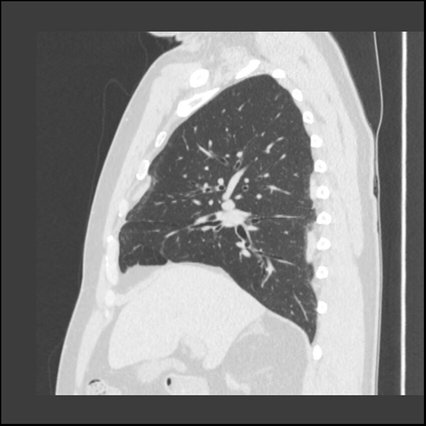 Asbestosis (Radiopaedia 45002-48961 Sagittal lung window 89).jpg