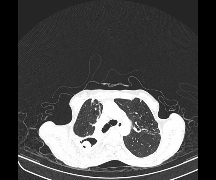 File:Aspergillomas (Radiopaedia 66779-76110 Axial lung window 19).jpg