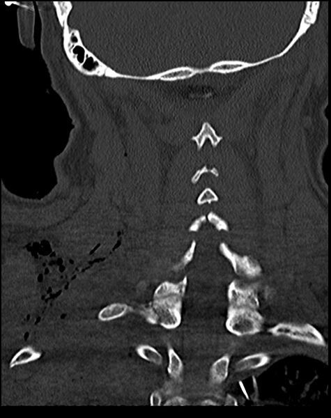 File:Atlanto-occipital dissociation - Traynelis type 1 (Radiopaedia 87570-103948 Coronal bone window 43).jpg