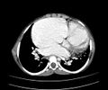 Atrial septal defect complicated by Eisenmenger syndrome (Radiopaedia 53707-59768 Axial C+ CTPA 18).jpg
