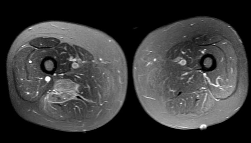Atypical lipomatous tumor - thigh (Radiopaedia 68975-78734 Axial PD fat sat 55).jpg