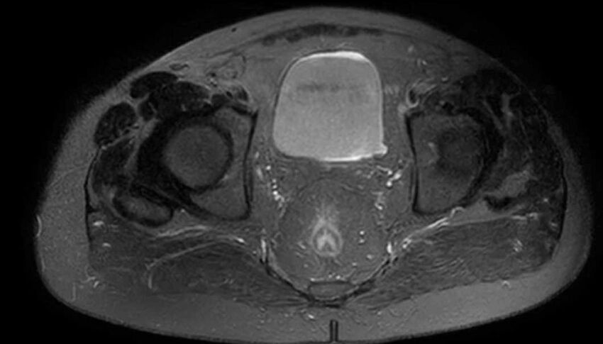 Atypical lipomatous tumor - thigh (Radiopaedia 68975-78734 Axial T2 fat sat 96).jpg