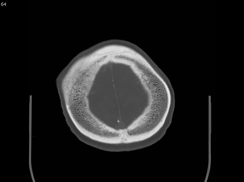 Atypical meningioma - intraosseous (Radiopaedia 64915-73867 Axial C+ bone window 64).jpg