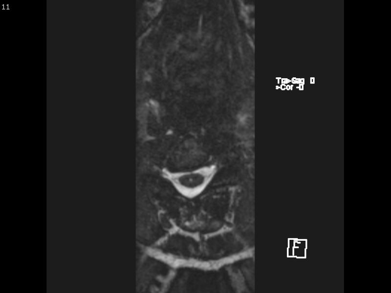 File:Atypical meningioma - intraosseous (Radiopaedia 64915-74572 Axial CISS 11).jpg