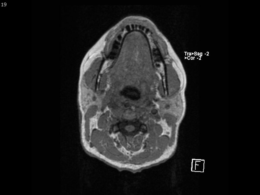 Atypical meningioma - intraosseous (Radiopaedia 64915-74572 Axial T1 19).jpg