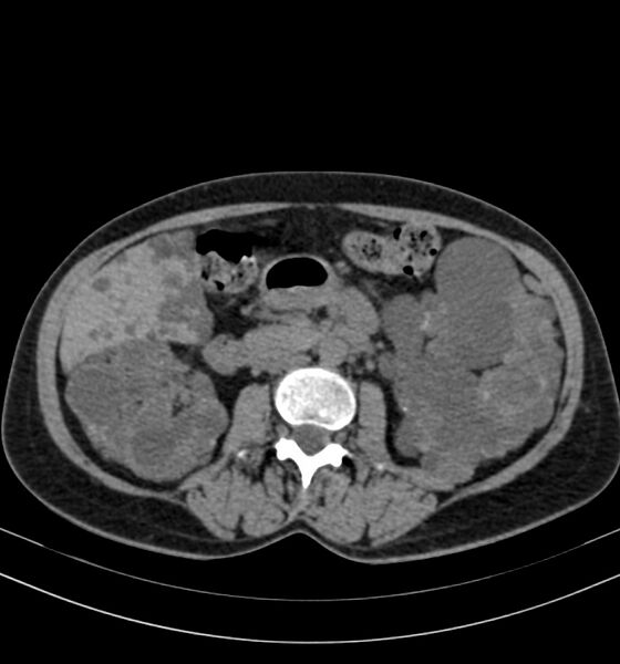 File:Autosomal dominant polycystic kidney disease (Radiopaedia 41918-44922 Axial non-contrast 15).jpg