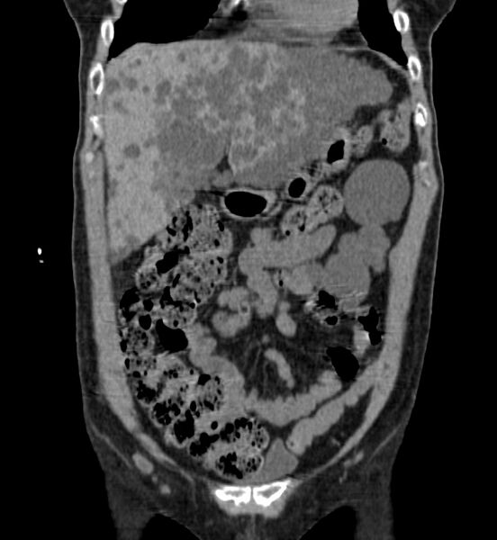 File:Autosomal dominant polycystic kidney disease (Radiopaedia 41918-44922 Coronal non-contrast 2).jpg