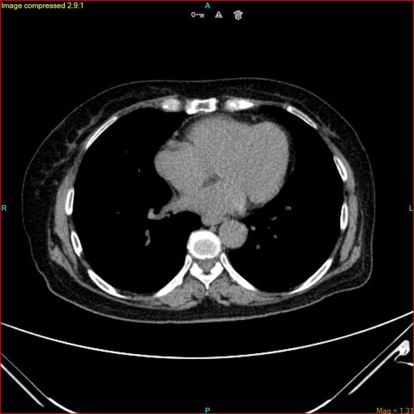 File:Azygos vein aneurysm (Radiopaedia 77824-90130 A 38).jpg