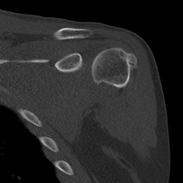 File:Bankart lesion (Radiopaedia 22771-22798 Coronal bone window 12).jpg