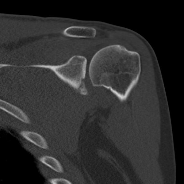 File:Bankart lesion (Radiopaedia 22771-22798 Coronal bone window 16).jpg