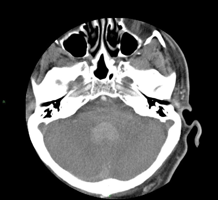 Basal ganglia hemorrhage (Radiopaedia 58763-65985 D 45).jpg