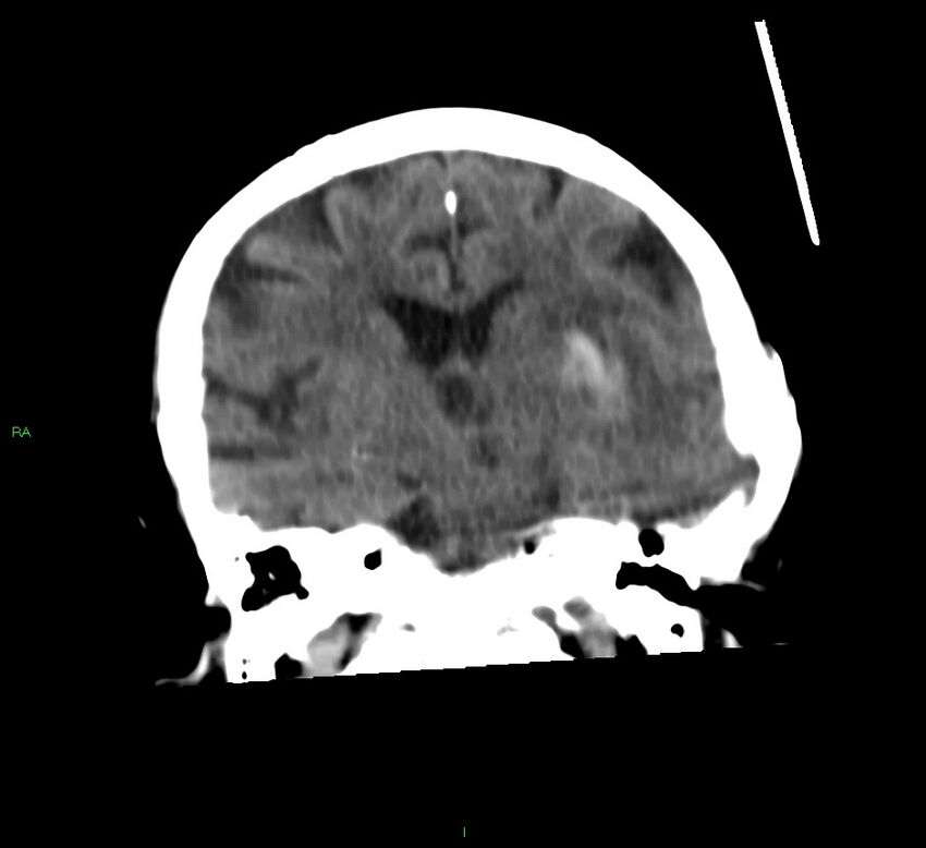 Basal ganglia hemorrhage (Radiopaedia 58790-66024 Coronal non-contrast 31).jpg
