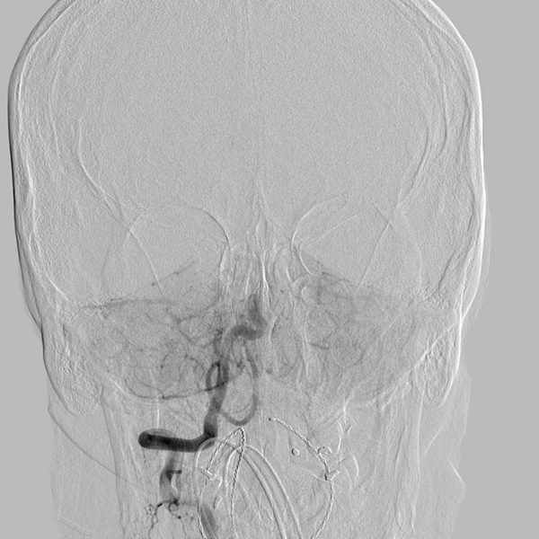 File:Basilar artery occlusion (Radiopaedia 33570-34668 RT VERT IC 21).png