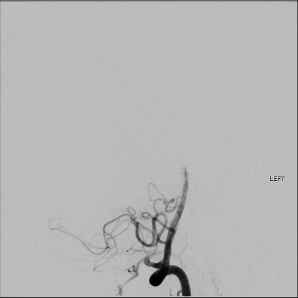 File:Basilar tip thrombus with endovascular clot retrieval (Radiopaedia 46320-50726 A 8).png