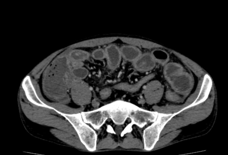 File:Behçet's disease- abdominal vasculitis (Radiopaedia 55955-62570 A 65).jpg