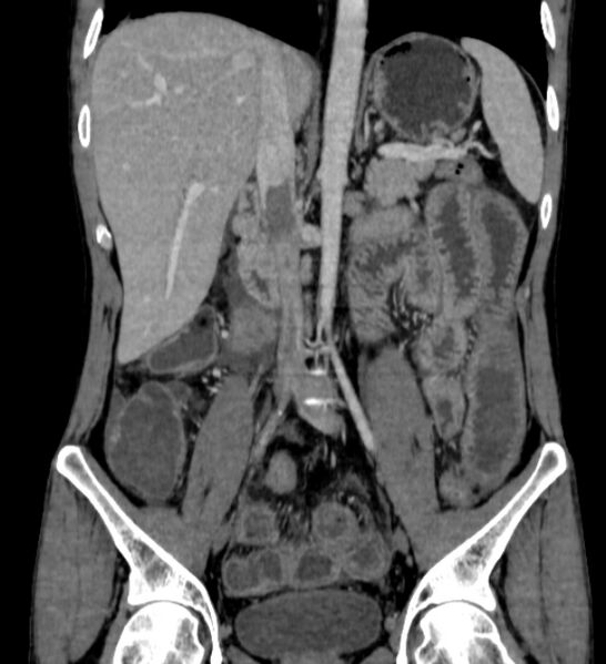 File:Behçet's disease- abdominal vasculitis (Radiopaedia 55955-62570 B 30).jpg