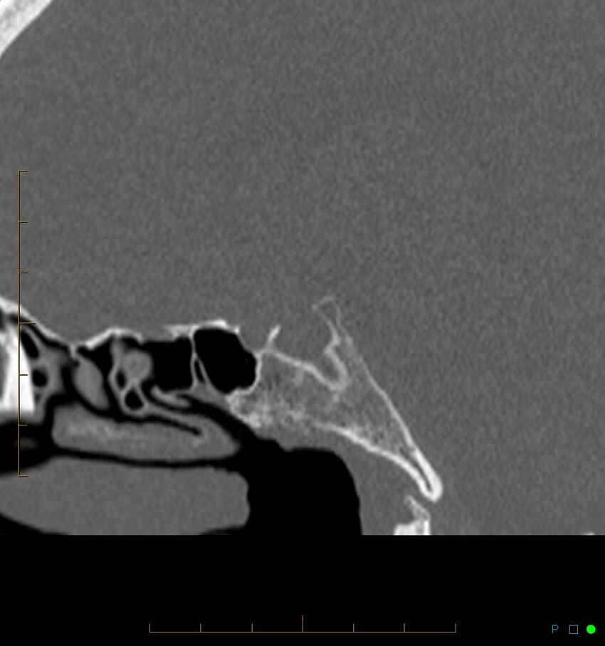 Benign notochordal cell tumor (probable) (Radiopaedia 65475-74546 Sagittal bone window 31).jpg