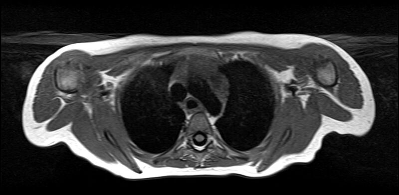 File:Bilateral Sprengel deformity with Klippel-Feil syndrome (Radiopaedia 66395-75650 Axial T1 26).jpg
