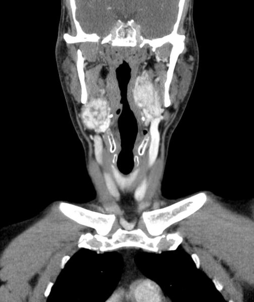 File:Bilateral carotid body tumors (Radiopaedia 52899-58827 B 9).jpg
