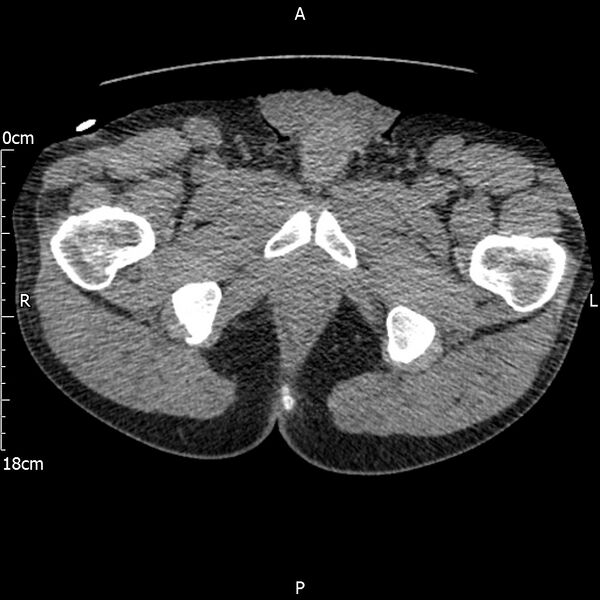 File:Bilateral medullary nephrocalcinosis with ureteric calculi (Radiopaedia 71269-81569 Axial non-contrast 142).jpg