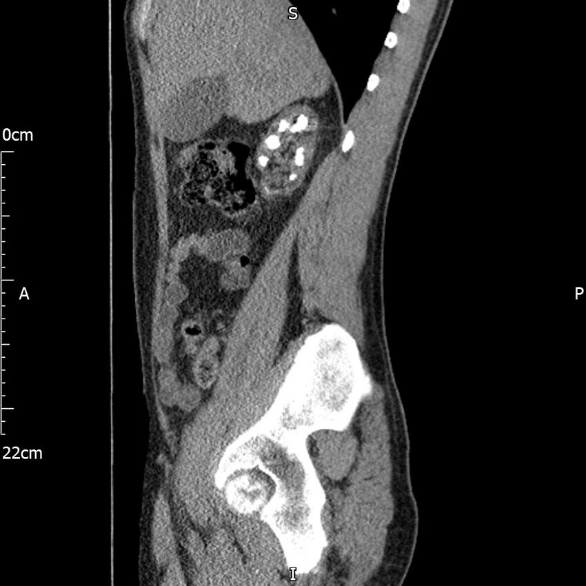 Bilateral medullary nephrocalcinosis with ureteric calculi (Radiopaedia 71269-81569 C 80).jpg